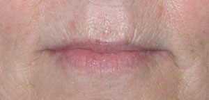 Lip Augmentation - Patient 6 - Before